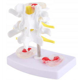 Ludzki model przepukliny dysku lędźwiowego