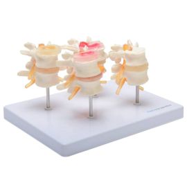 Model krążków międzykręgowych z chorobami