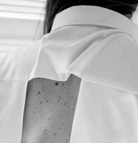 Łupież pstry - czy jest zaraźliwy?