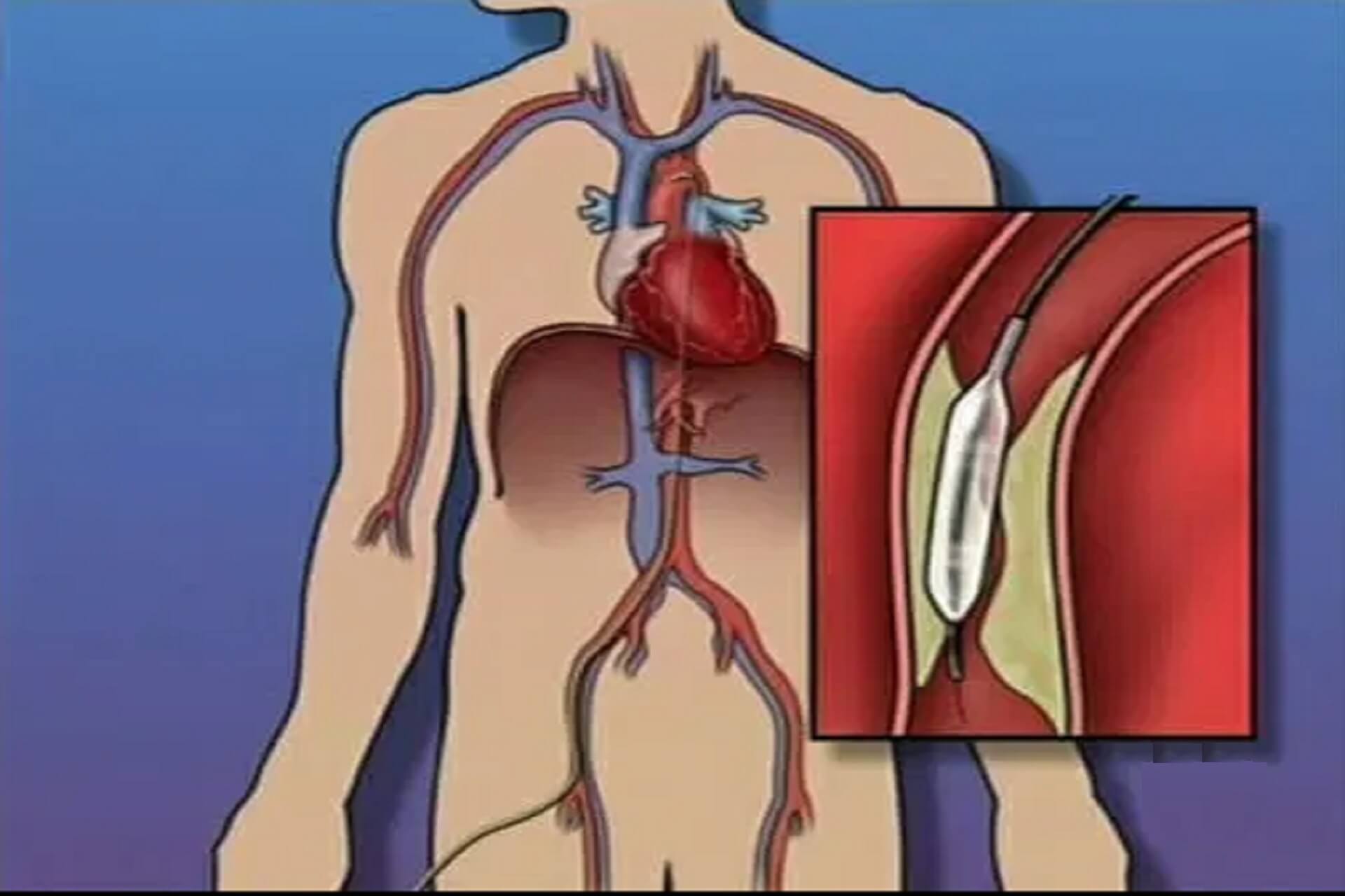 Angioplastyka balonowa