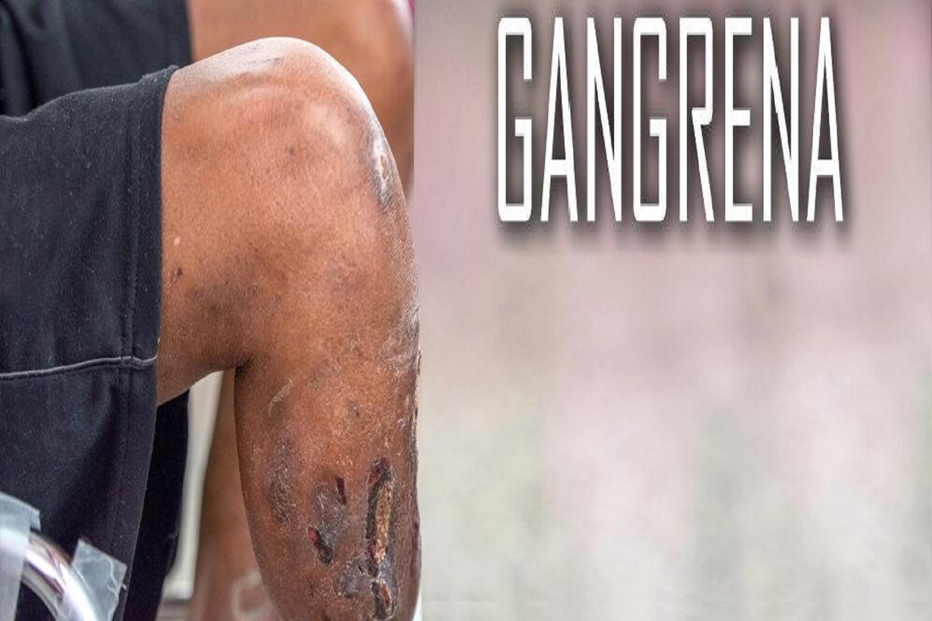 Gangrena – czym jest? Przyczyny, objawy i leczenie