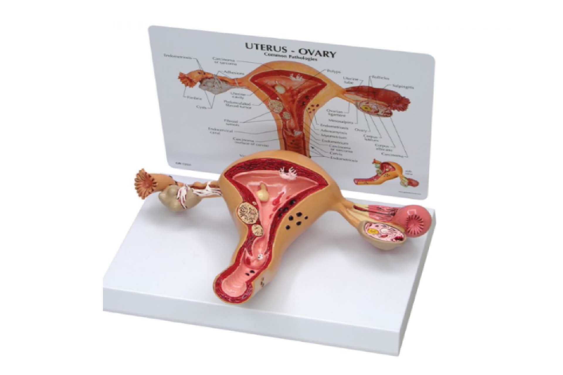 Torbiel jajnika – przyczyny, objawy i leczenie