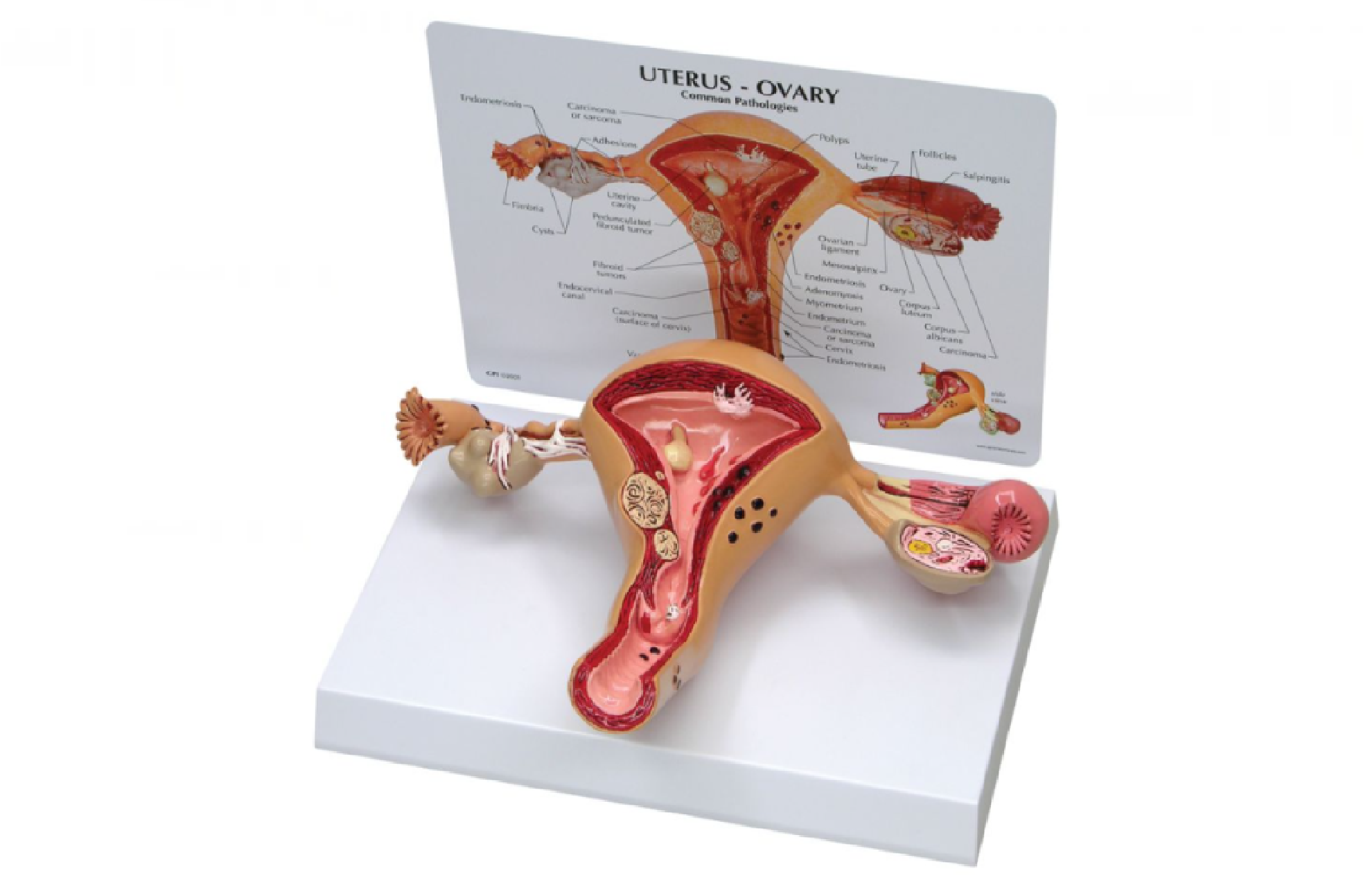 Rak jajnika – przyczyny, objawy i leczenie