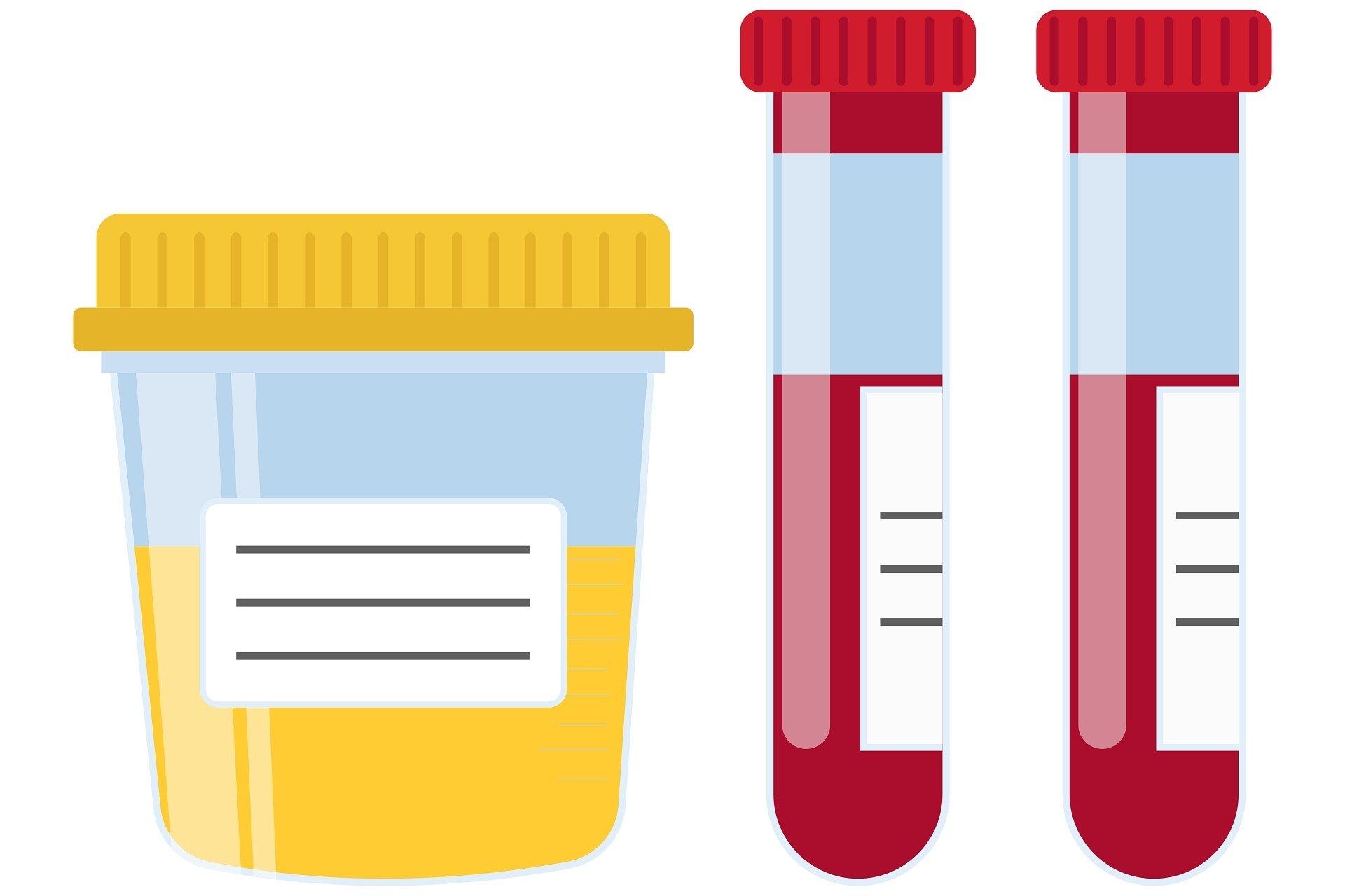 Ketonuria – przyczyny, objawy i znaczenie kliniczne