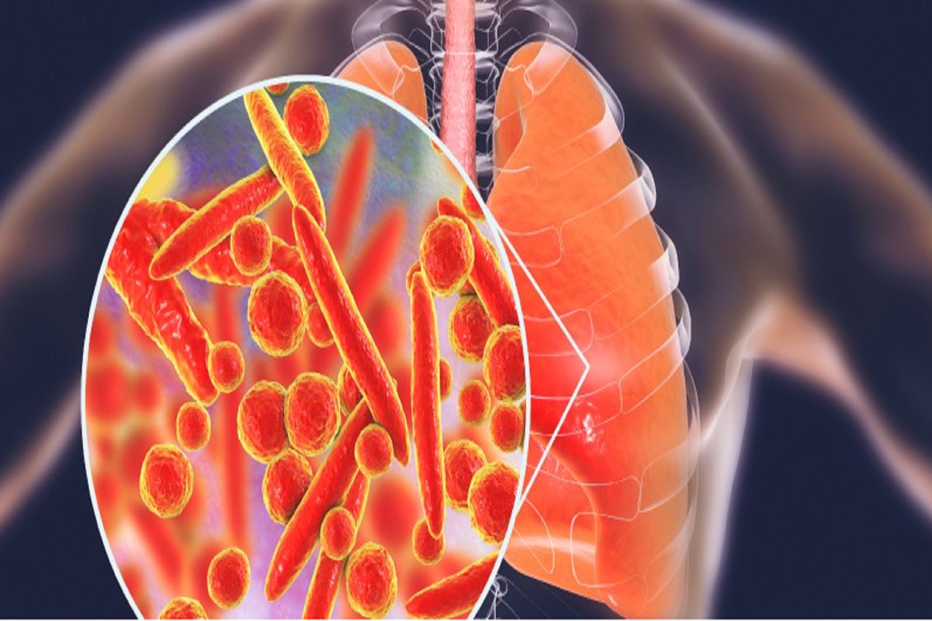 Mykoplazmowe zapalenia płuc - przyczyny objawy i leczenie
