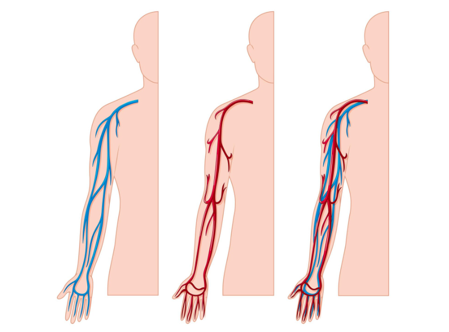 GUZKOWE ZAPALENIE TĘTNIC