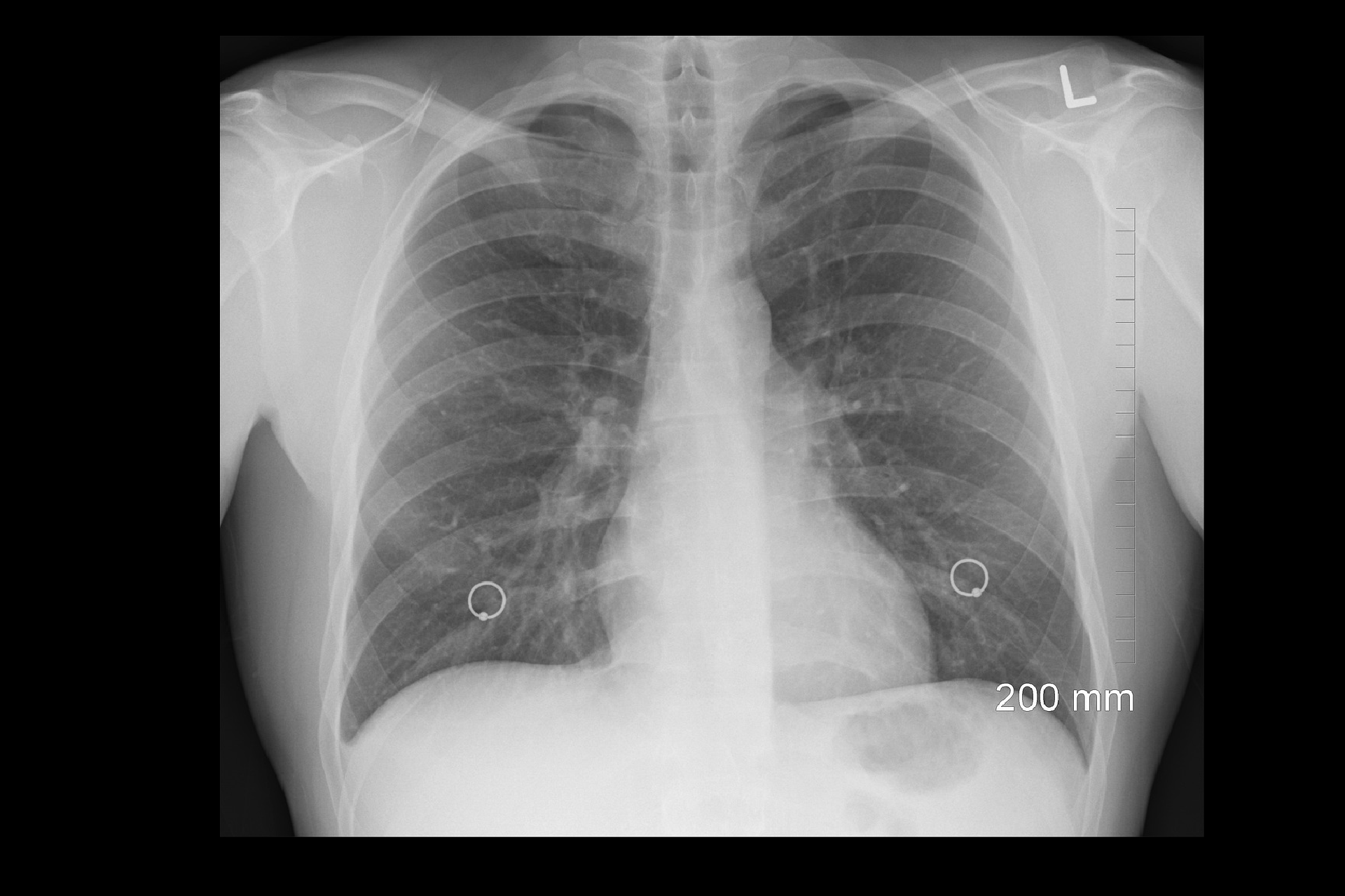 Idiopatyczne włóknienie płuc