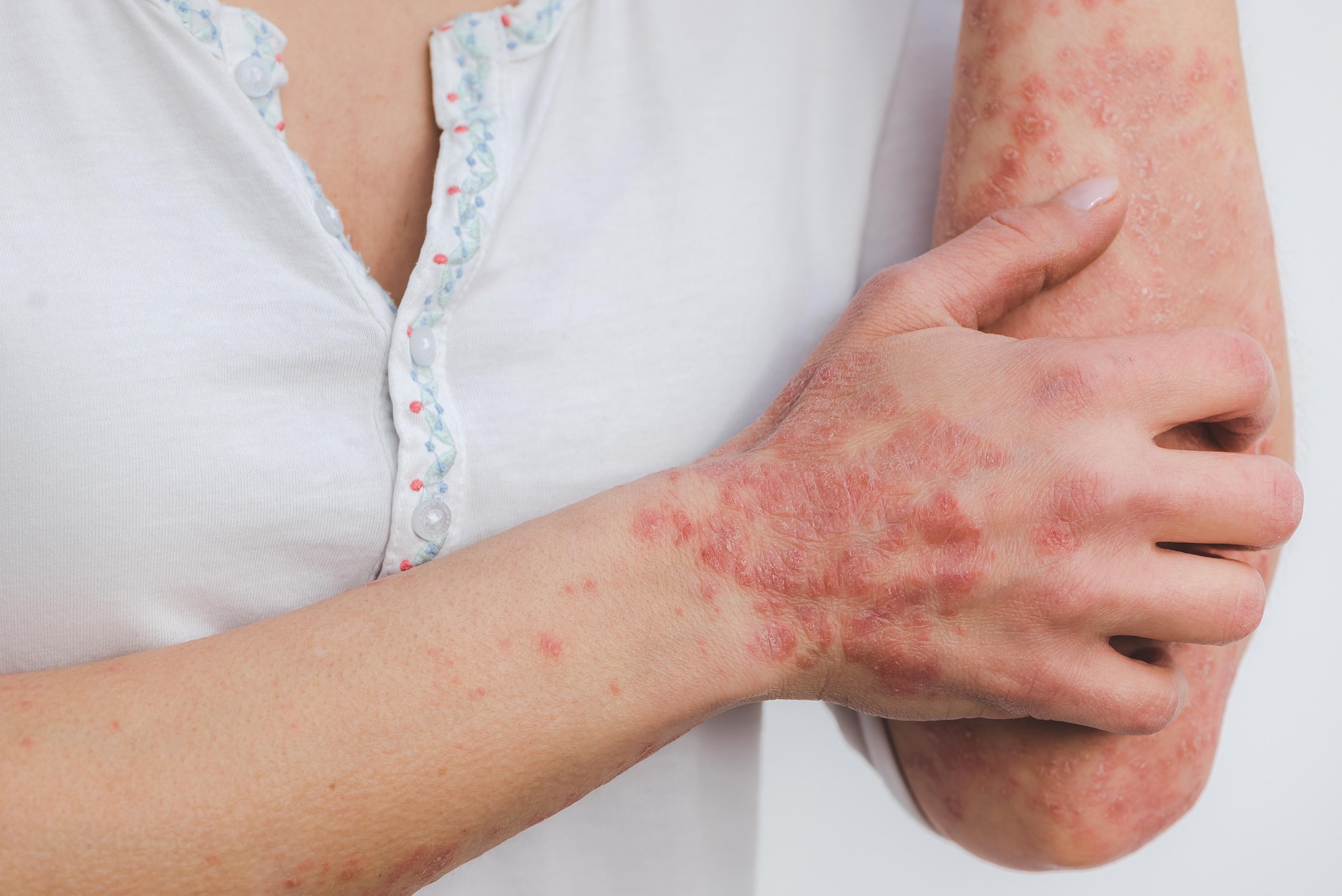 Erytrodermia łuszczycowa – groźne powikłanie łuszczycy