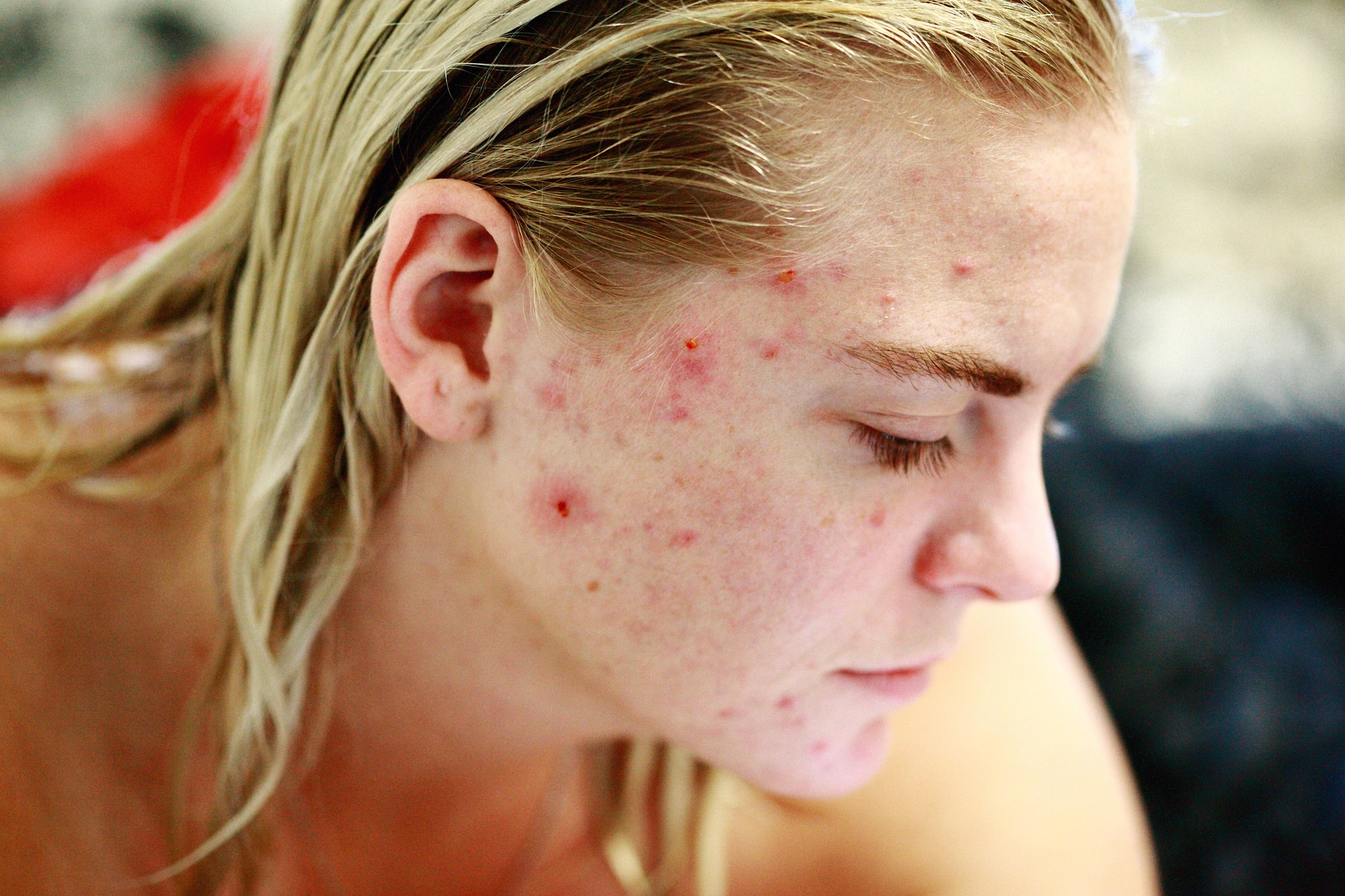 Erythema multiforme (rumień wielopostaciowy)