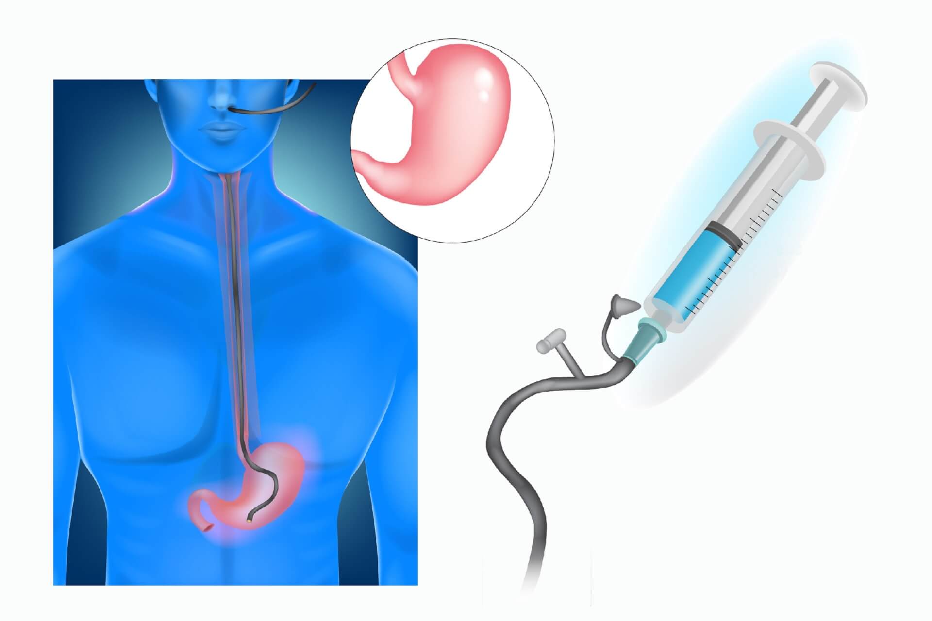 Sondy (zgłębniki) żołądkowe